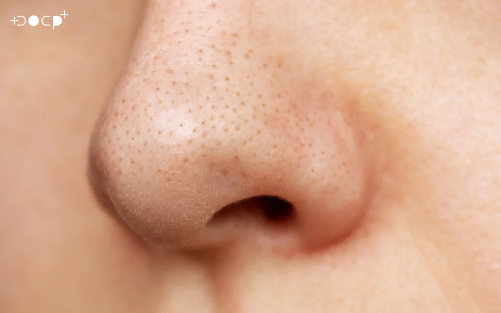 Blackhead On a Persons Nose