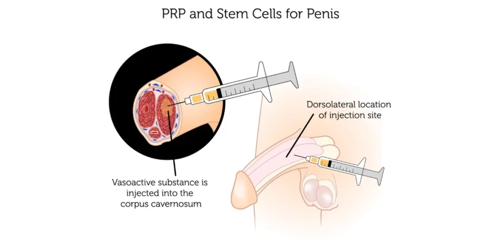 prp and stem cells for penis